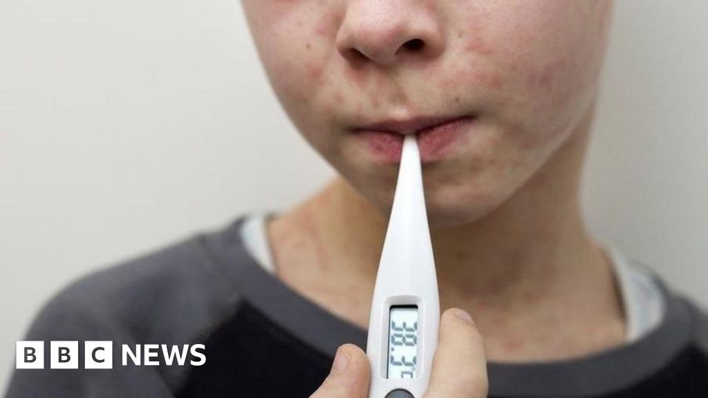 UK loses measles elimination status